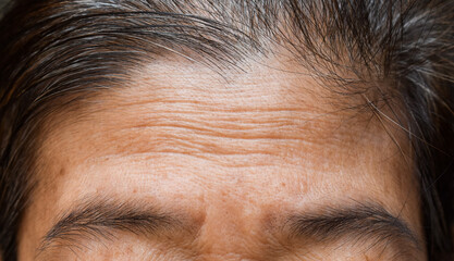 Skin creases or wrinkles at oily forehead of Southeast Asian, Myanmar or Burmese elder woman. Symptom of aging. - obrazy, fototapety, plakaty