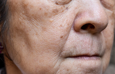 Enlarged pores in face of Asian, elder woman with skin folds.