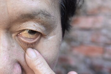 Pale skin of Asian man. Sign of anemia. Pallor at eyelid. - obrazy, fototapety, plakaty
