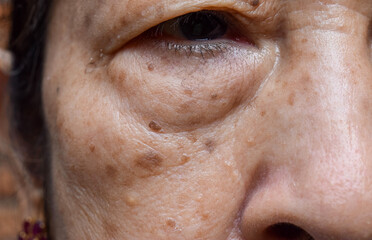 Small brown patches called age spots on face of Asian elder woman. They are also called liver...