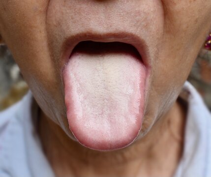 Coated tongue or white tongue. Loss of taste called ageusia.