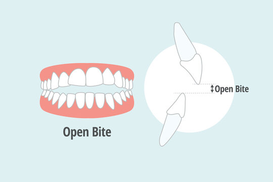 icon dental problem. vectorial illustration Open bite