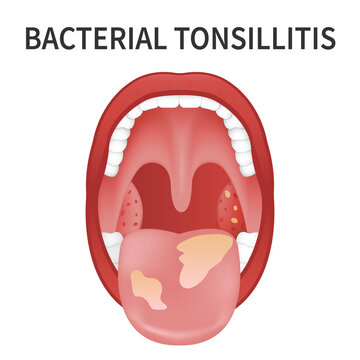 Bacterial and viral tonsillitis. Angina, pharyngitis, and tonsillitis. Tonsil infection. Open Mouth