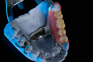 Removable plastic partial denture on white background