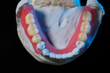 Removable plastic partial denture on white background