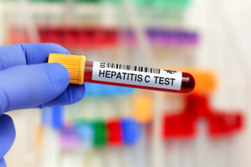 Blood sample for study of Hepatitis C Virus HCV in the lab. doctor holding Blood tube for HCV Hepatitis C Virus analysis and identification