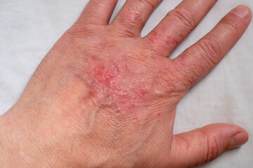 Healing burns on the arm. Scars on the skin of the hand after a burn.
