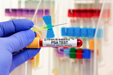 doctor with Blood tube and catheter for PSA Prostate specific antigen test in biochemistry lab. Blood sample of patient for PSA Free and PSA Total tests in laboratory