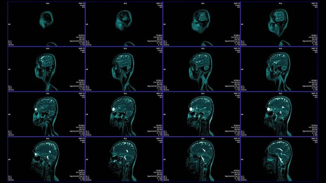 Magnetic resonance images of the brain (MRI brain), 16x1 split screen sagittal plane axial view sequence in cine mode. T2-weighted MRI (T2-TSE-TRA-P2) showing normal anatomy