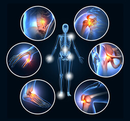 Painful joints, rheumatoid arthritis, osteoarthritis, 3D illustration - obrazy, fototapety, plakaty