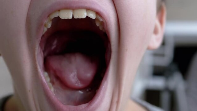A Tired, Sleepy Child Opens his Mouth Wide, Yawns Shows his Teeth, Tongue. Change in facial expression. Portrait of teenager opening his mouth, close-up of his face. Grimace, part of the face.