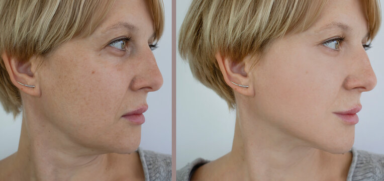 woman double chin before and after treatment