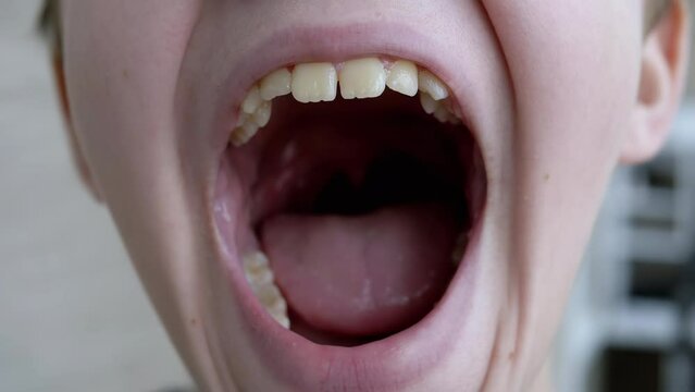 A Tired, Sleepy Child Opens his Mouth Wide, Yawns Shows his Teeth, Tongue. Change in facial expression. Portrait of teenager opening his mouth, close-up of his face. Grimace, part of the face.