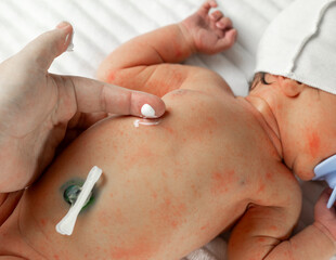 diaper rash in babies and care for them from the first days of birth