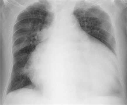 chest x-ray image of cardiomegaly 
