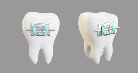 3d illustration of the installed arc in the lock, braces with ligatures.
