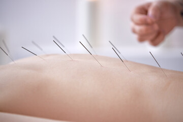 hand of professional doctor performing acupuncture therapy for female client. woman undergoing acupuncture treatment with a line of fine needles inserted into the her body skin in clinic hospital - obrazy, fototapety, plakaty