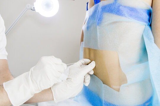 The doctor is about to inject a blockade in the back. The introduction of anesthesia in the back before childbirth. Preparing the patient before surgery. 