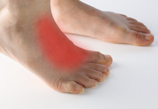 Close up human foot with red area to point of pain on top of foot on extensor tendonitis caused by tight shoe, flat feet, prolong standing , muscle tightness in children isolated on white background.