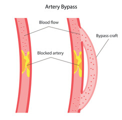 coronary artery bypass surgery, and colloquially heart bypass or bypass surgery