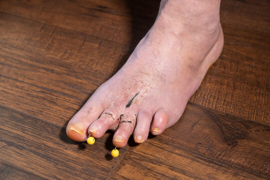 Image of older male's foot post hammertoe surgery with pins extending out of the second and third toe. The photo shows dry skin around the foot after being covered for six weeks.