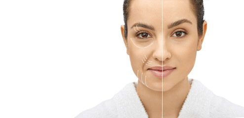 Woman's face before and after skin tightening and anti-aging procedures. Remove of wrinkles,...