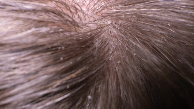 Macro video of human hair with dandruff. Head wounds and itching, hair care, seborrheic treatment
