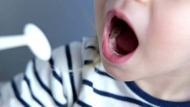 dentist, doctor examines oral cavity of small patient, uses mouth mirror, closeup baby teeth child, concept pediatric dentistry, dental treatment, correction of occlusion, oral care, caries prevention
