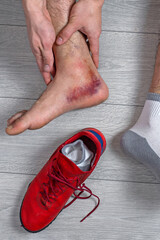 Ankle injury with dislocation and sprains. Fracture or Leg sprain injury of young sports man. 