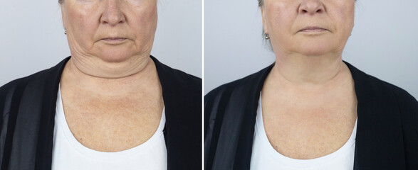 Photos before and after plastic surgery to remove Venus rings. Contour plastics of the neck,...