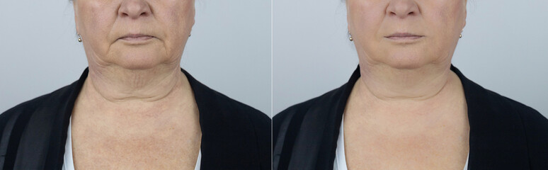 Senior woman shows the result facelift. Removal wrinkles around mouth. Corners mouth. Fight against...