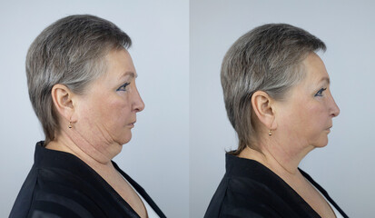 Second chin lift in senior woman. Photos before and after plastic surgery, mentoplasty or...