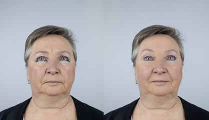 Eye lift. An elderly woman shows herself before and after a facelift. The concept of medical and...