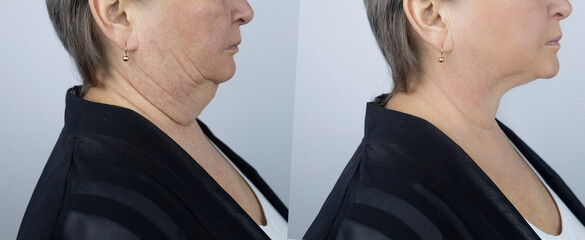 Photos before and after plastic surgery to remove Venus rings. Contour plastics of the neck, mesotherapy or botulinum therapy. Wrinkles and creases in the neck - obrazy, fototapety, plakaty