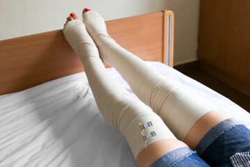 Postoperative elastic bandage on the legs of a girl