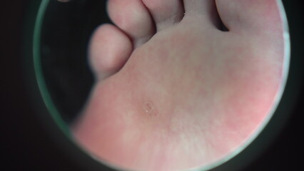 Fototapeta premium A magnifying glass zooms in on a wart on a girl's leg in a podiatrist's salon. View of the leg through a large magnifying glass.