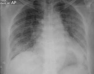 chest x-ray image of covid 19 pneumonia patient show consolidation multifocal on lungs bilateral