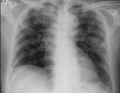 chest x-ray image of covid 19 pneumonia patient show consolidation multifocal on lungs bilateral