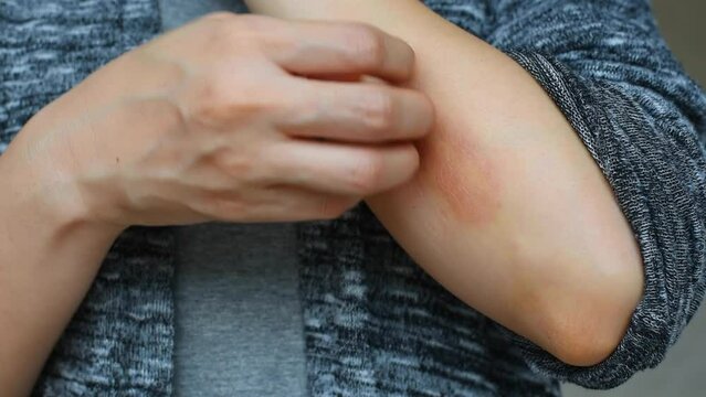 Woman itching skin scratch allergy diseases problem, Close up of atopic dermatitis rash, Female dermatology patient with allergic eczema on arm.
