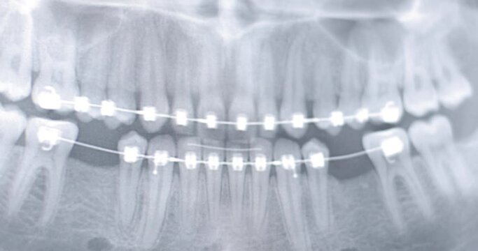 X-ray image of the human jaw, skeleton, bite teeth, dentistry, orthodontics, braces on the teeth, black-and-white image, dentist, the process of making a plate for teeth, product photography, close-up
