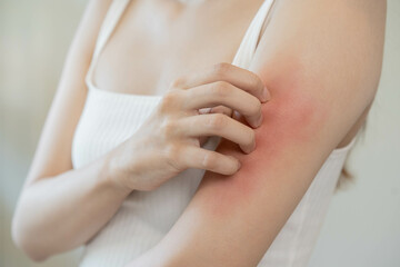 Dermatology, asian young woman, girl hand in her arm allergy, allergic reaction from atopic, insect bites, hand in scratching itchy, itch red spot or rash of skin. Beauty problem by medical treatment.