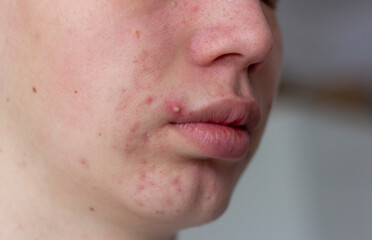 A picture of acne on the face of a teenager . Pimples, red scars and black dots on cheeks and chin. The concept of problem skin, care and beauty.