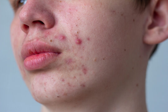 A Picture Of Acne On The Face Of A Teenager . Pimples, Red Scars And Black Dots On Cheeks And Chin. The Concept Of Problem Skin, Care And Beauty.