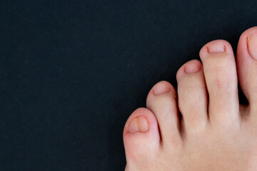 Female feet with big double little toe on black background