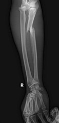 monteggia fracture, proximal ulna fracture with radial head dislocation, x ray 

