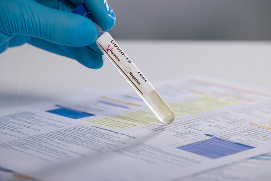 a hand in medical gloves is handling a positive coronavirus probe in front of a request form for analysis