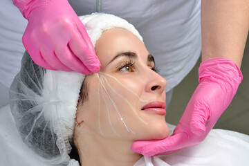 Thread lifting. Tightening of flabby skin in the jaw area with the help of cosmetic threads. Thread...