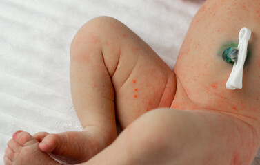 diaper rash in babies and care for them from the first days of birth