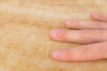 Fractured middle finger and the nail grew crooked