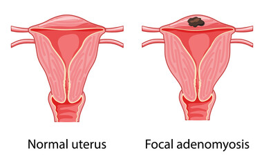 Focal Adenomyosis Human anatomy Female reproductive system diagram with text Sick and normal organ uterus vagina Cross section icon. Vector carton flat illustration isolated on white background